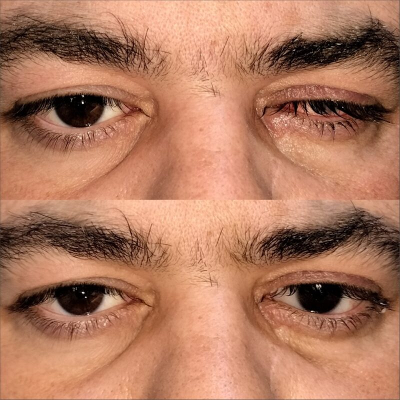 Prothèse oculaire LAB.O3 — résultat avant et après pose