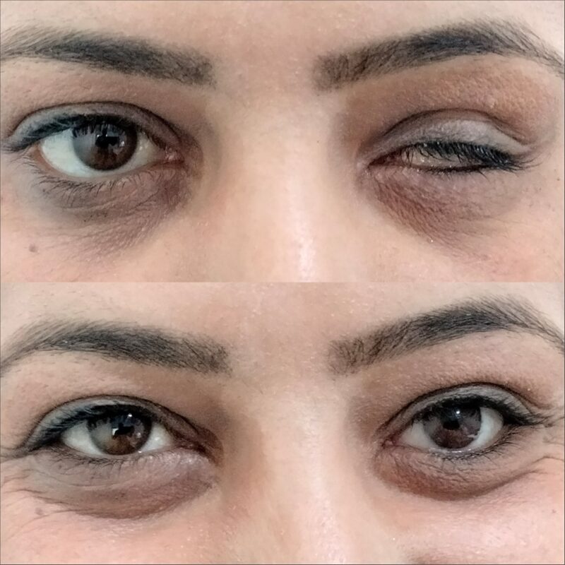 Prothèse oculaire sur mesure, comparaison avant/après — atelier LAB.O3 Sousse